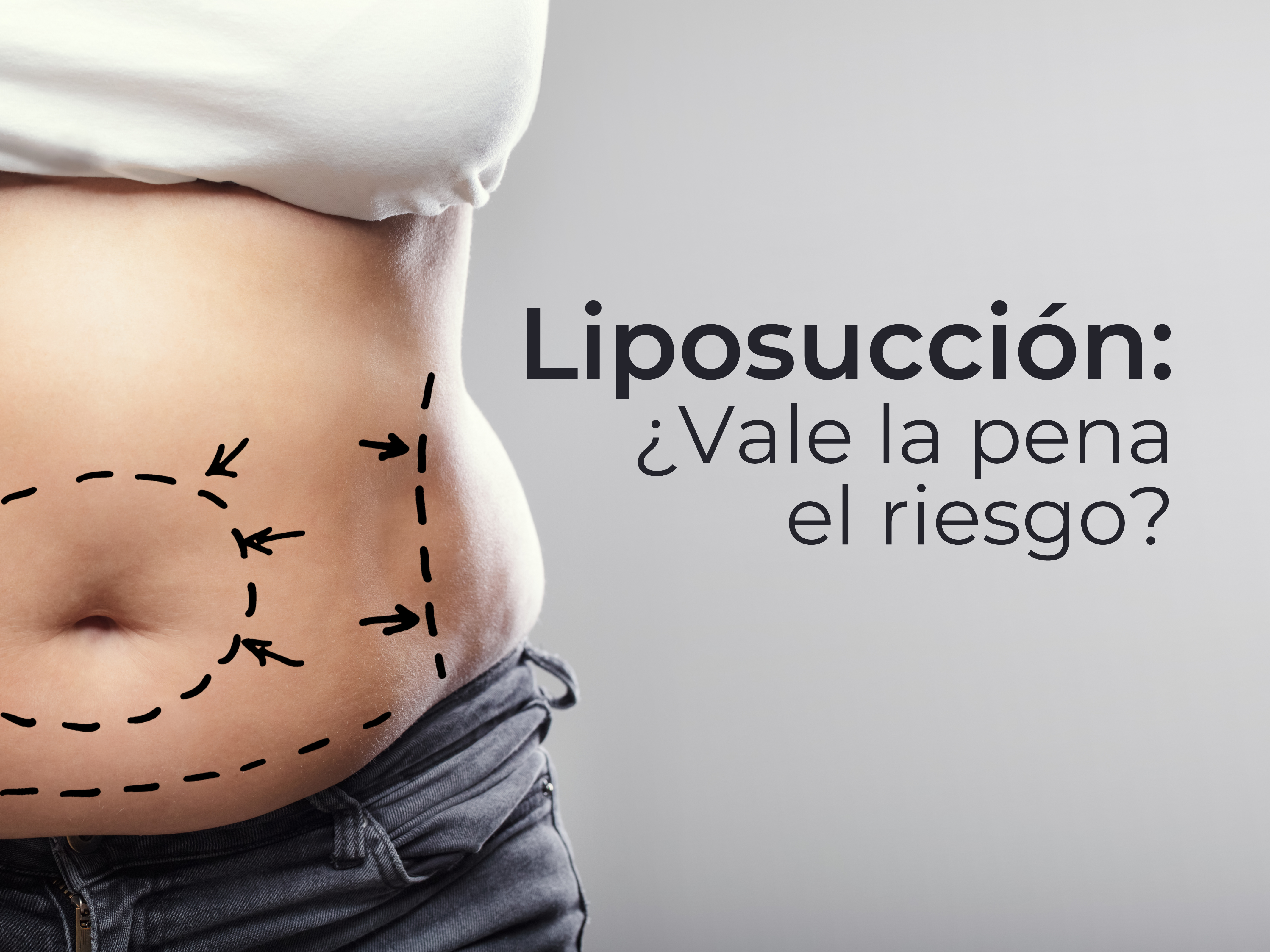 Liposucción: ¿Vale la pena el riesgo?